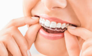 orthodontists-in-asheville-nc-invisalign-for-children