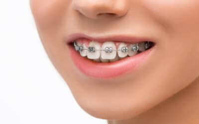 7 Facts To Know About Braces for All Age