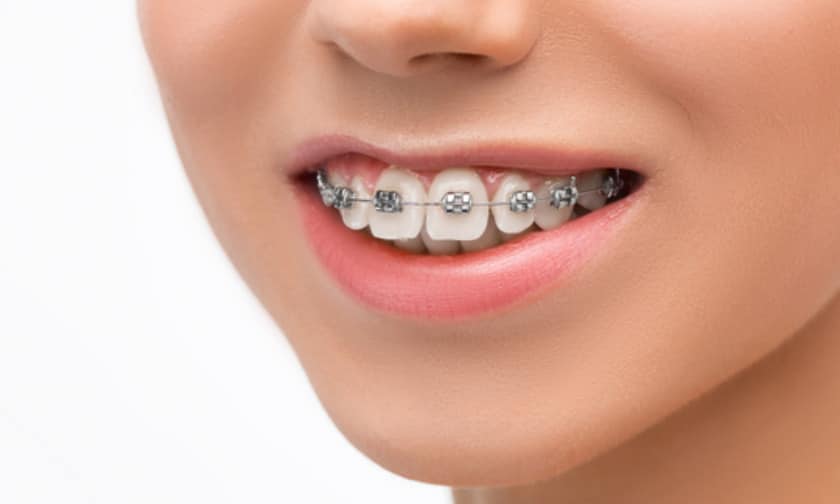 7 Facts To Know About Braces for All Age
