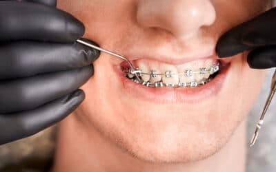 How to Convince Your Teen to get Braces?
