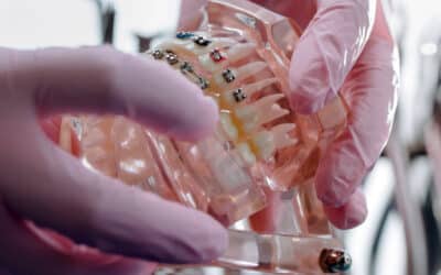 Braces Battle: Ceramic vs Metal – Which One Is Right For You?