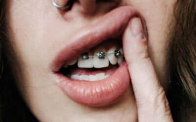 Does Metal Braces Work Faster Than Clear Aligners: Find Out Here!