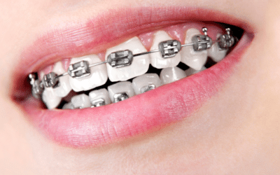 How to Properly Care for Your Metal Braces and Keep Them Clean