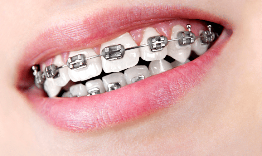 How to Properly Care for Your Metal Braces and Keep Them Clean