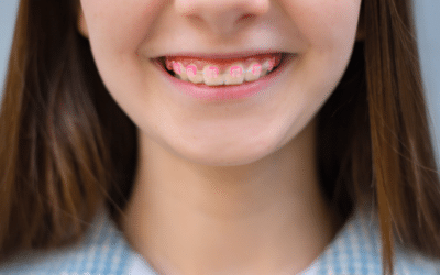 The Benefits of Early Orthodontic Treatment for Teens