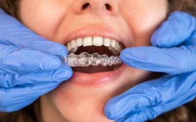 Top 7 Benefits of Choosing Invisalign in Asheville for Your Smile Transformation