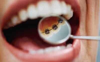 5 Proven Habits to Make Your Lingual Braces Work Better