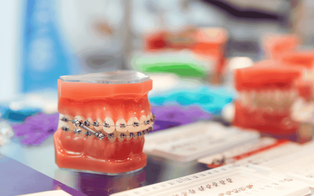 dental model with braces