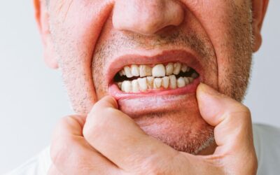 Do Misaligned Teeth Cause Tooth Wear?