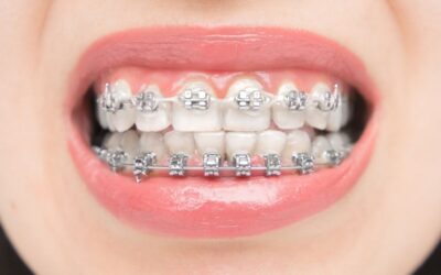 Can Loose Braces Wires Affect Your Treatment Results?