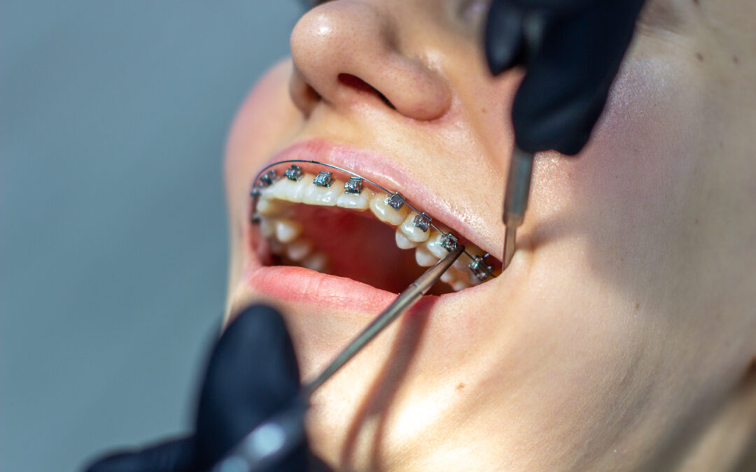 How Modern Braces Have Changed Over the Last Decade