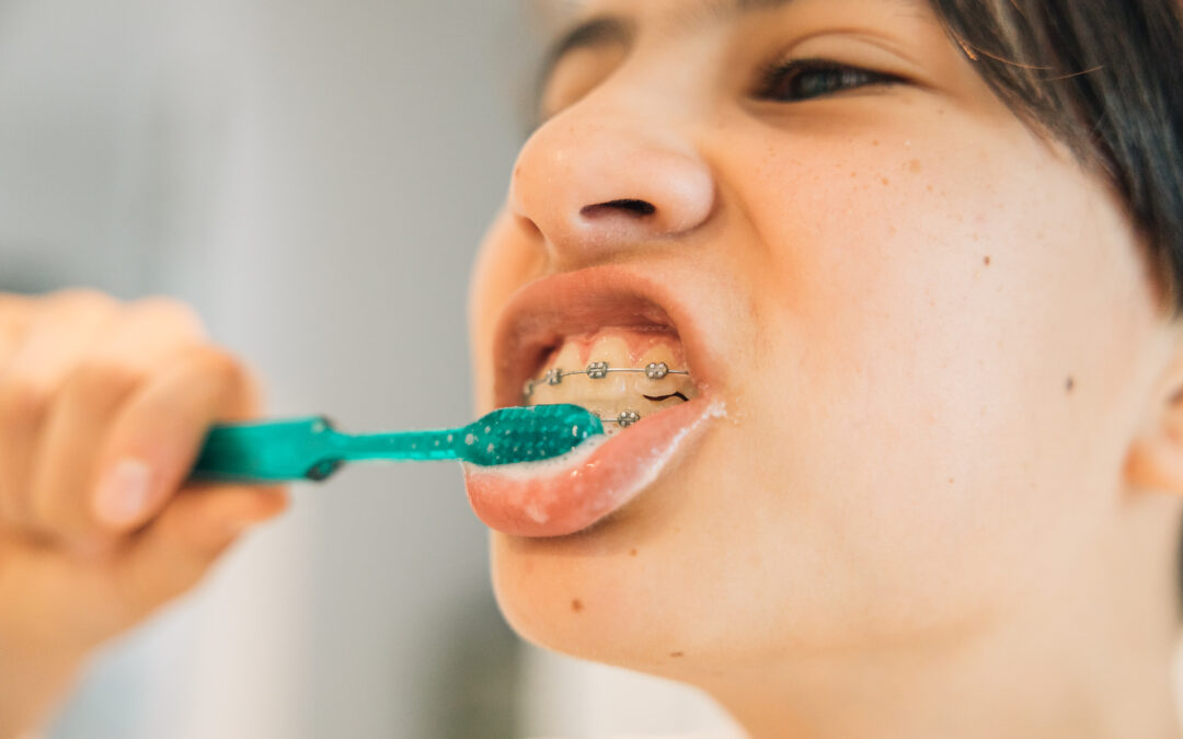 A Parent’s Guide to Braces for Teens