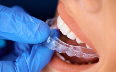 Do Clear Aligners Really Work? Experts Explain